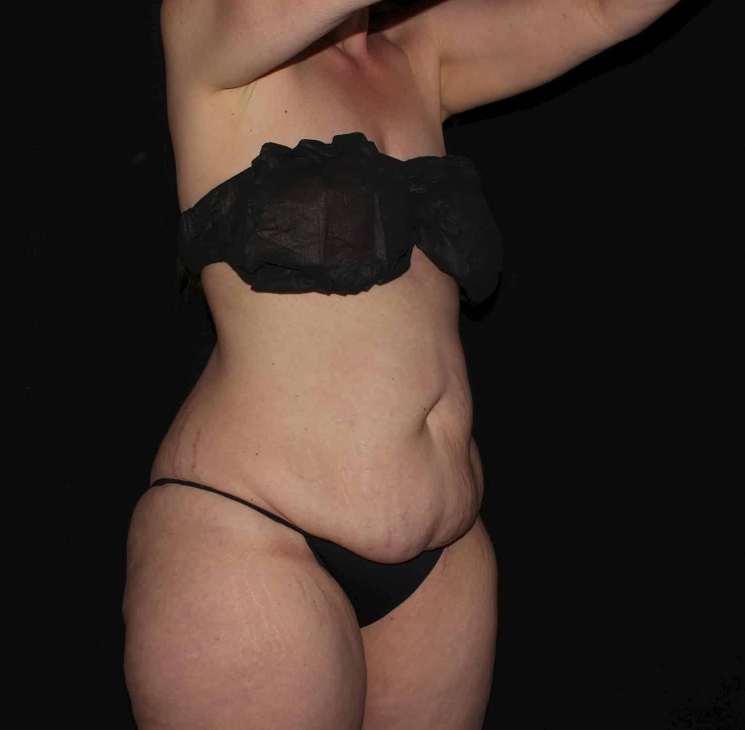 Before Image: Tummy Tuck - right-front-oblique