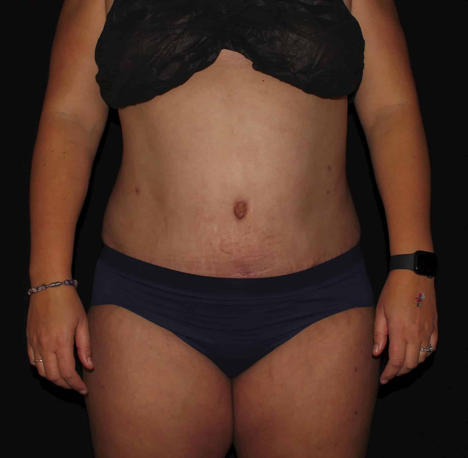 After Image: Tummy Tuck - front