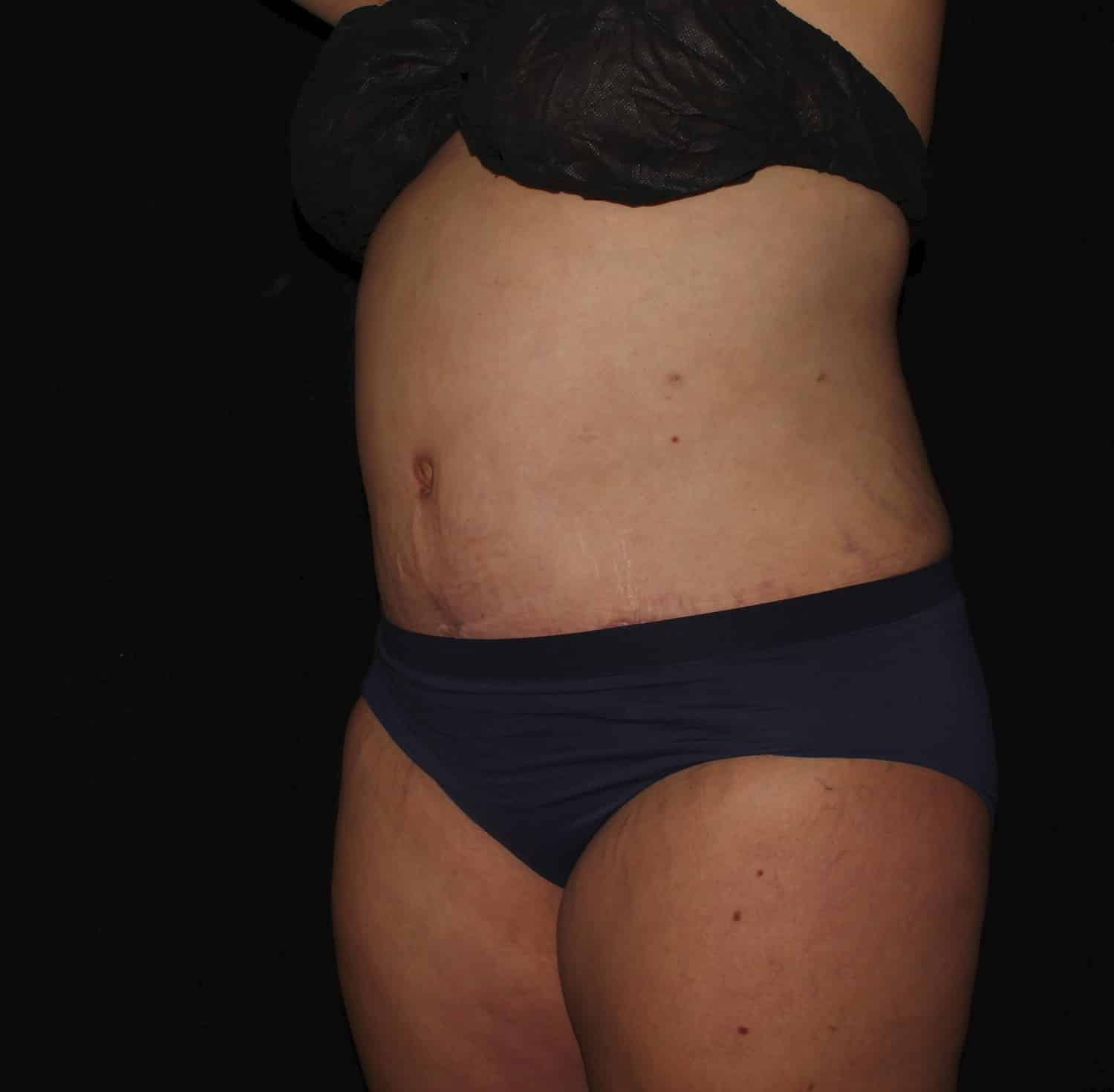 After Image: Tummy Tuck - left-front-oblique