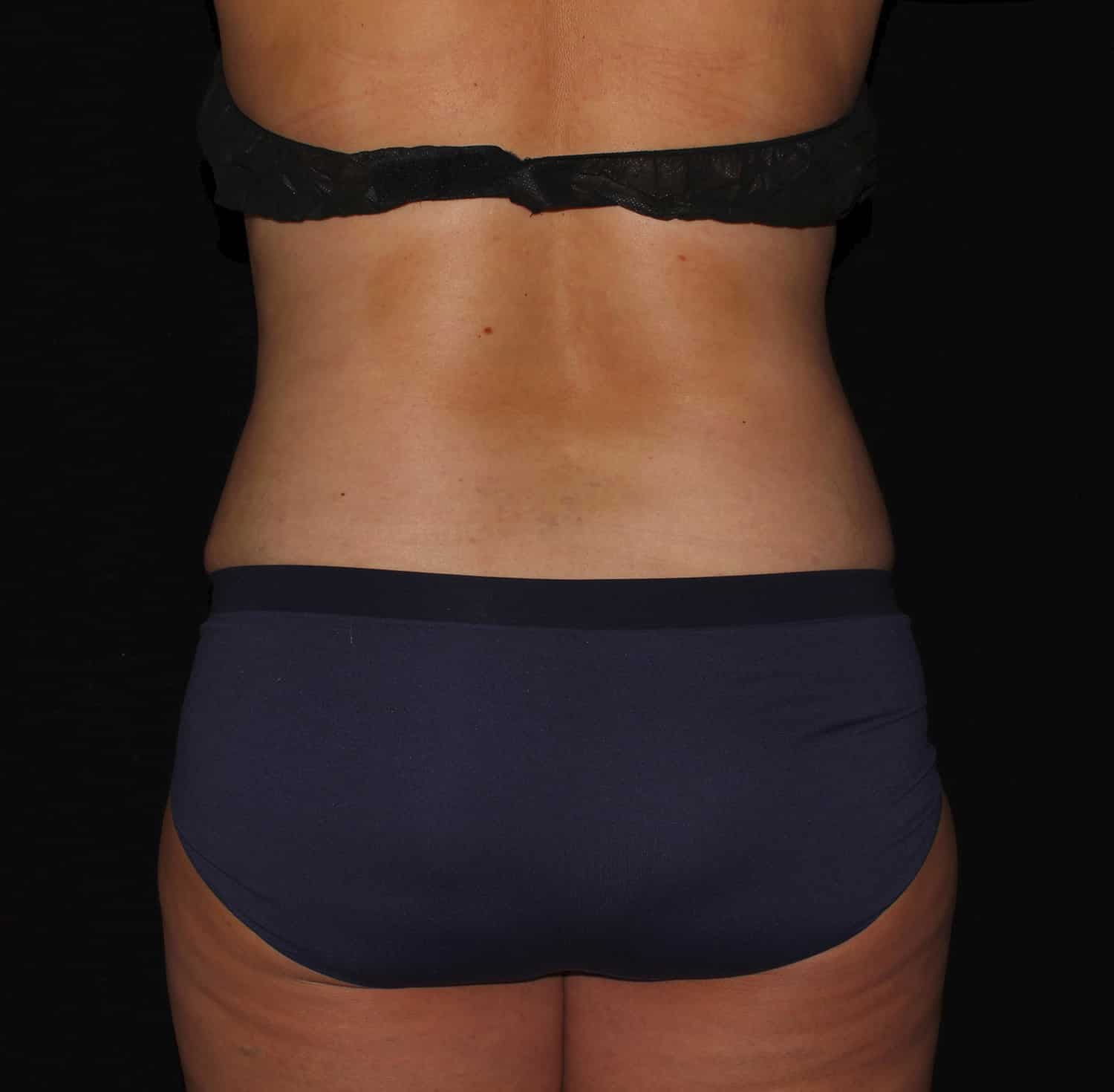 After Image: Tummy Tuck - back