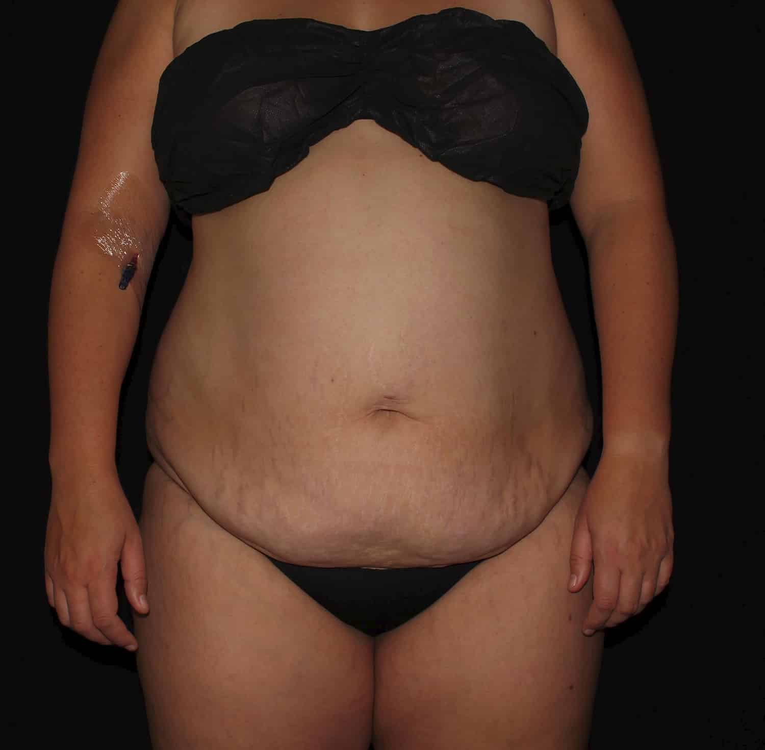 Before Image: Tummy Tuck - front