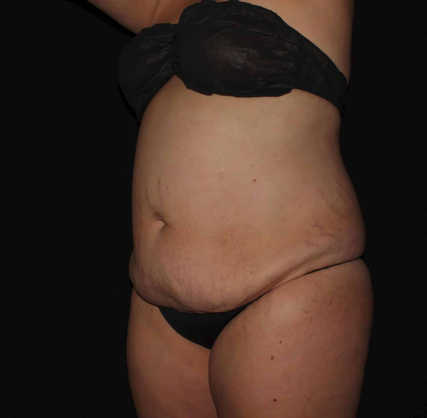 Before Image: Tummy Tuck - left-front-oblique