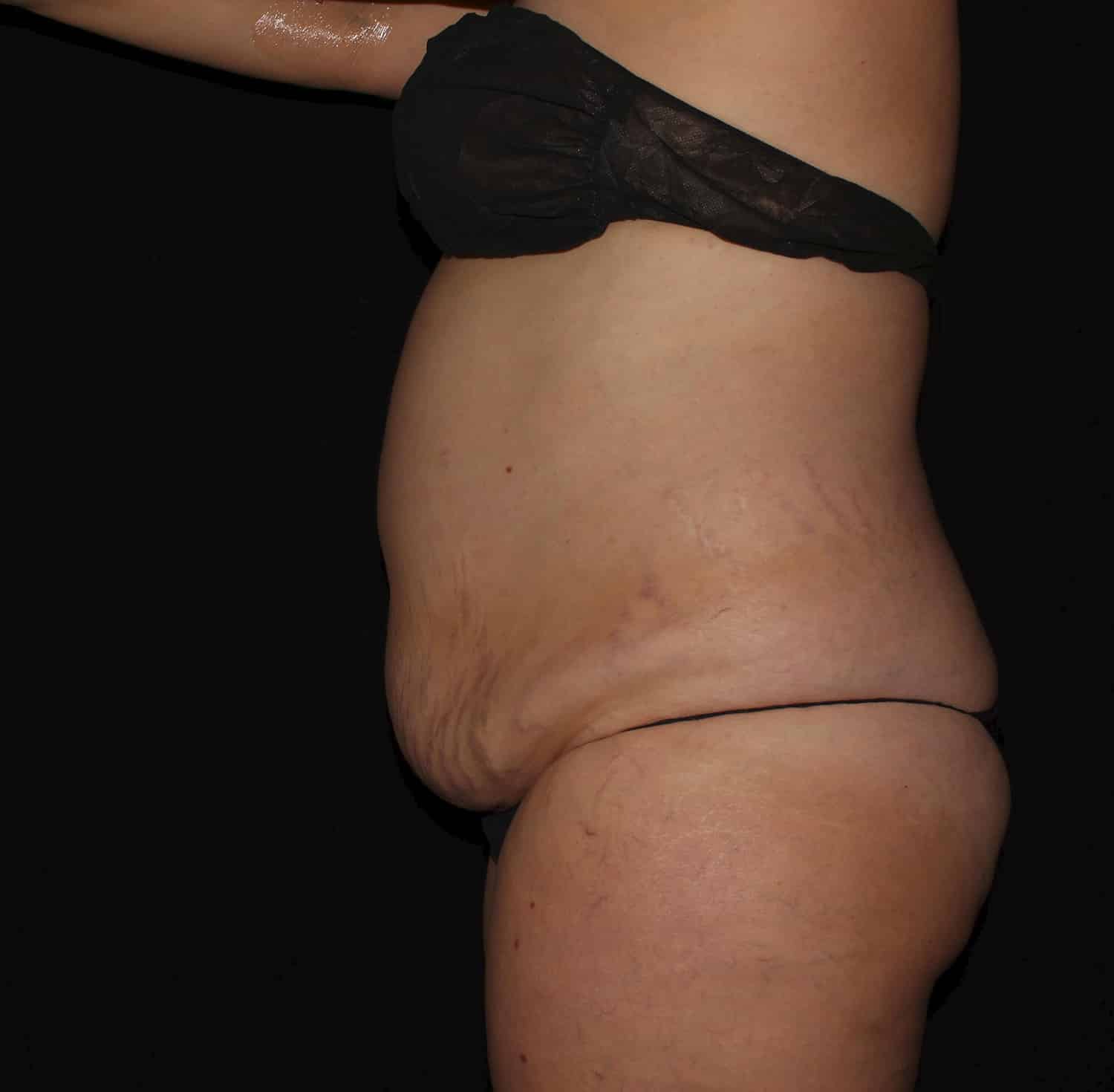 Before Image: Tummy Tuck - left-side