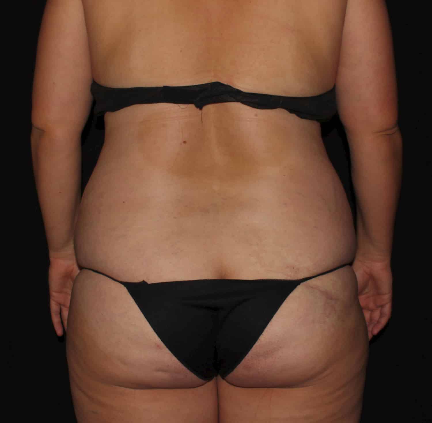 Before Image: Tummy Tuck - back