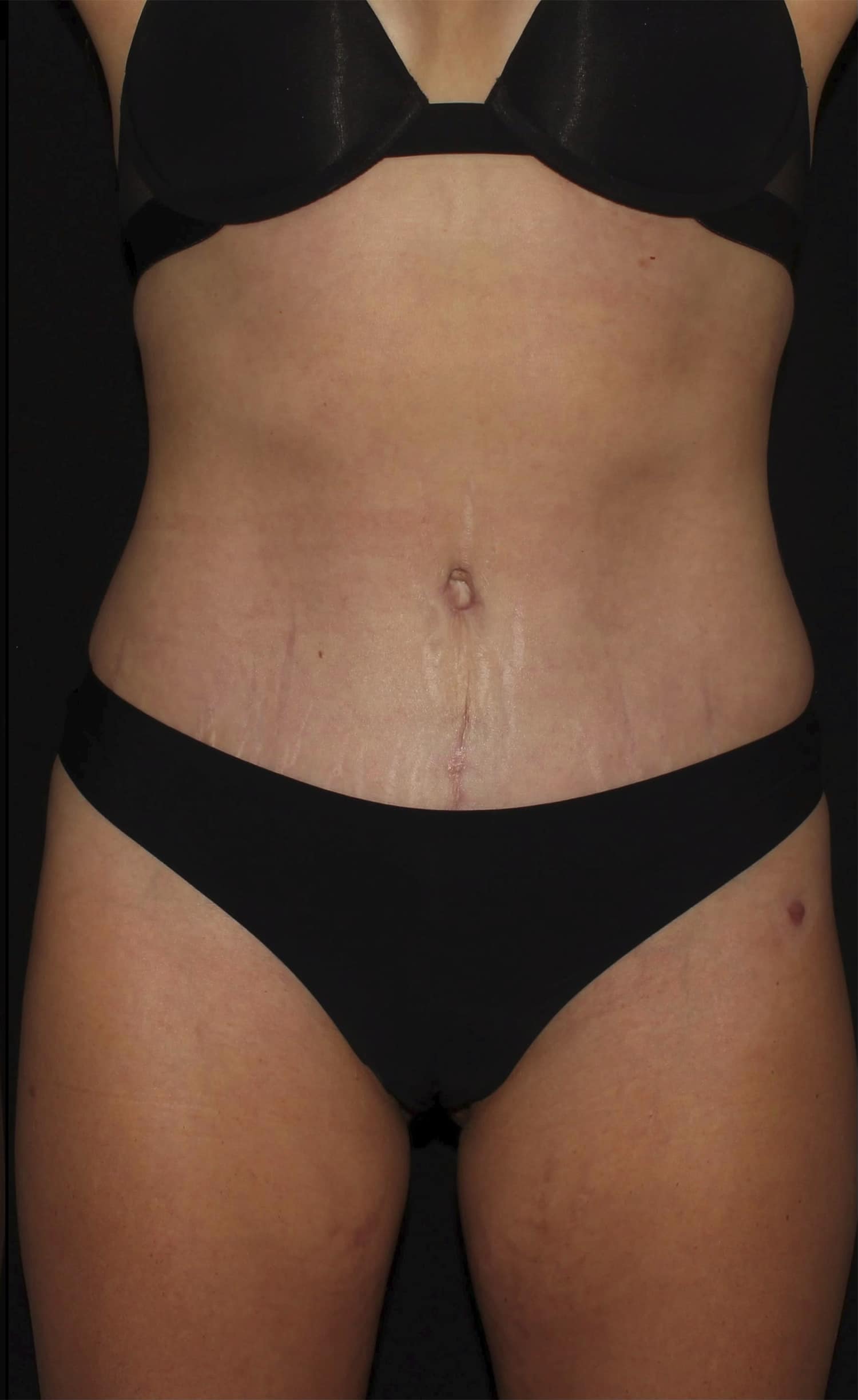 After Image: Abdominoplasty - front