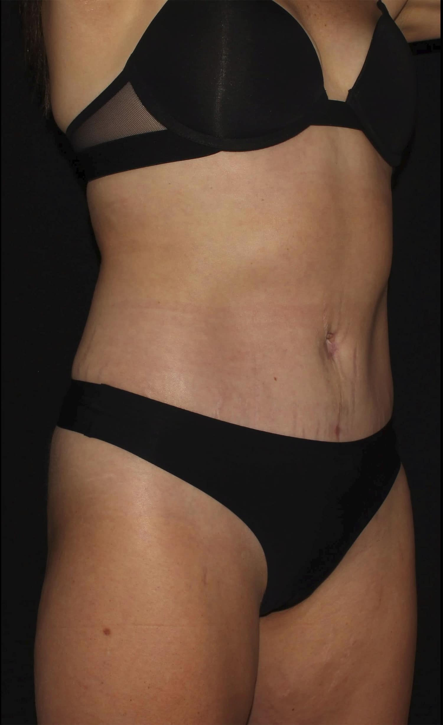 After Image: Abdominoplasty - right-front-oblique