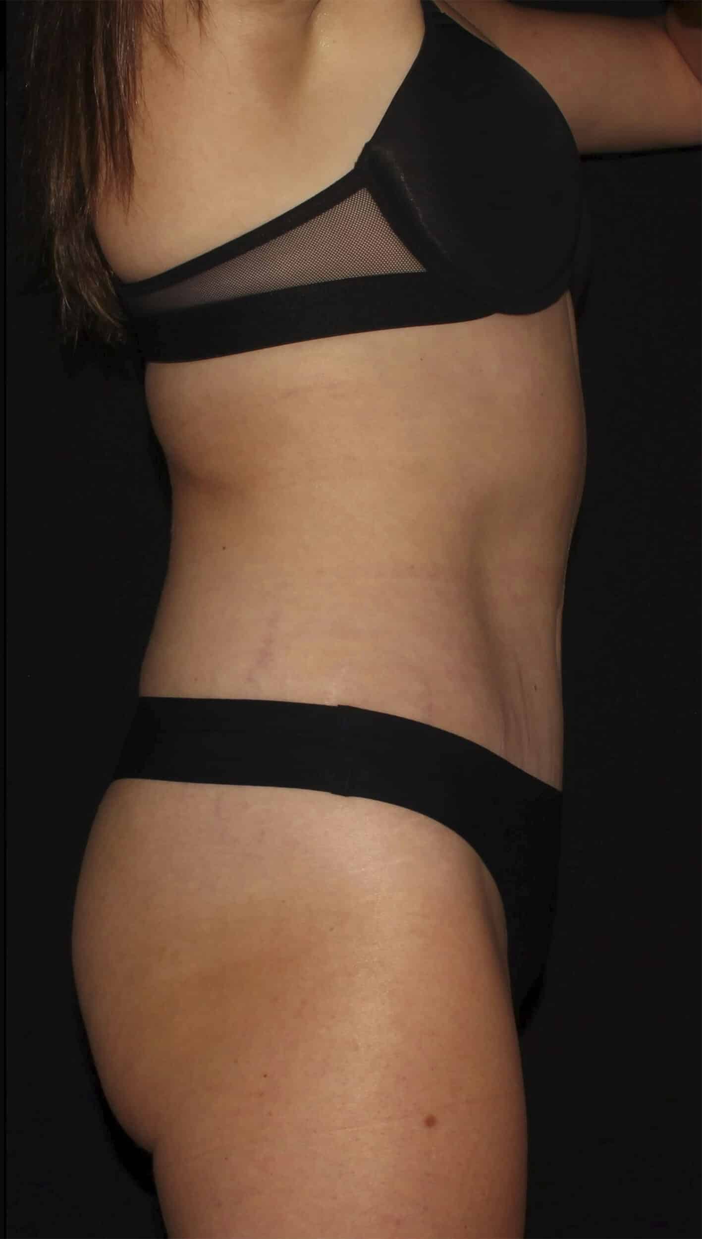 After Image: Abdominoplasty - right-side