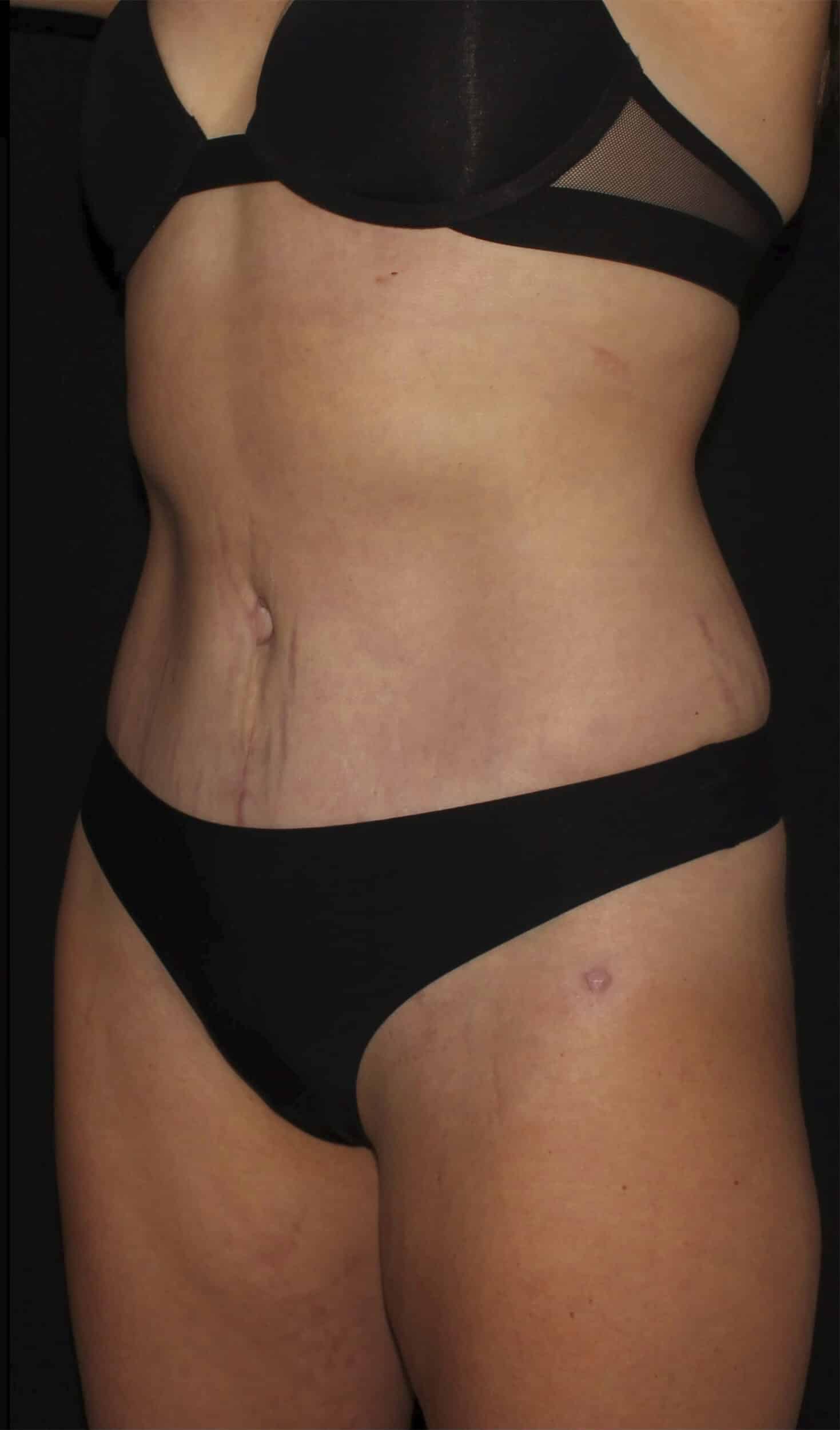 After Image: Abdominoplasty - left-front-oblique