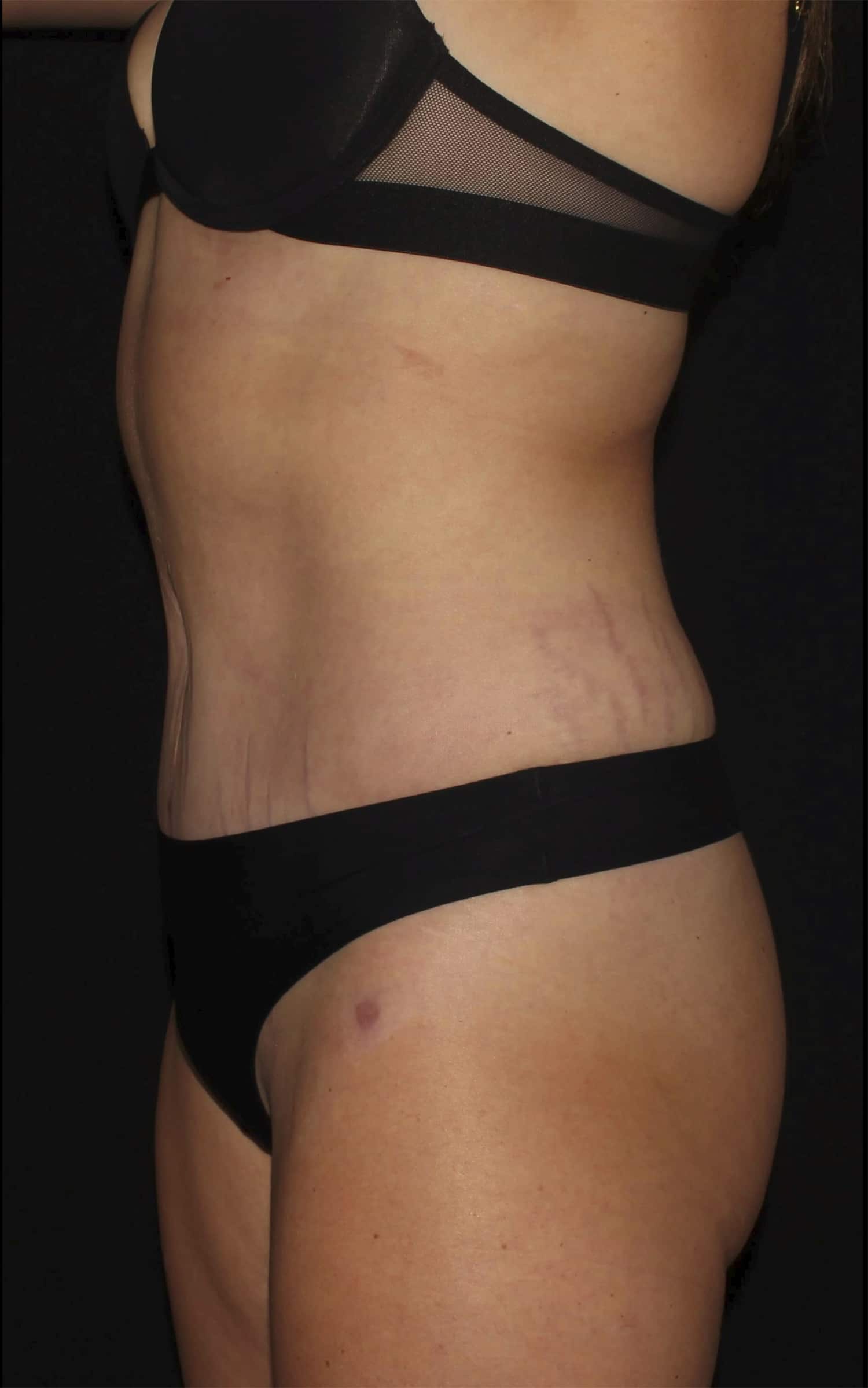 After Image: Abdominoplasty - left-side