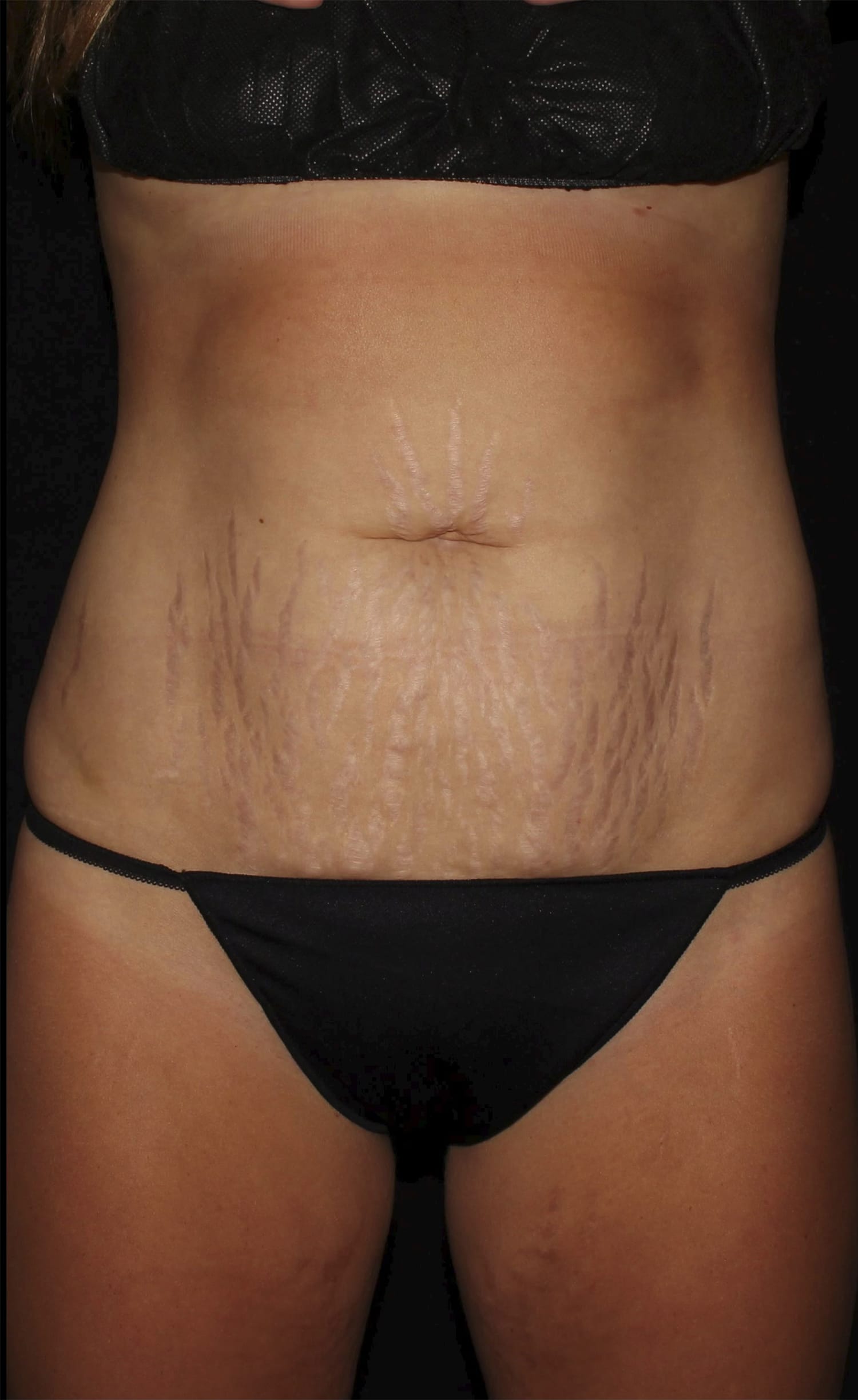 Before Image: Abdominoplasty - front