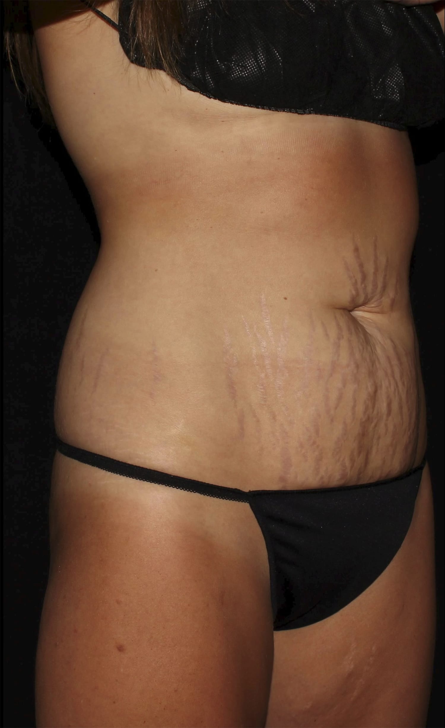 Before Image: Abdominoplasty - right-front-oblique