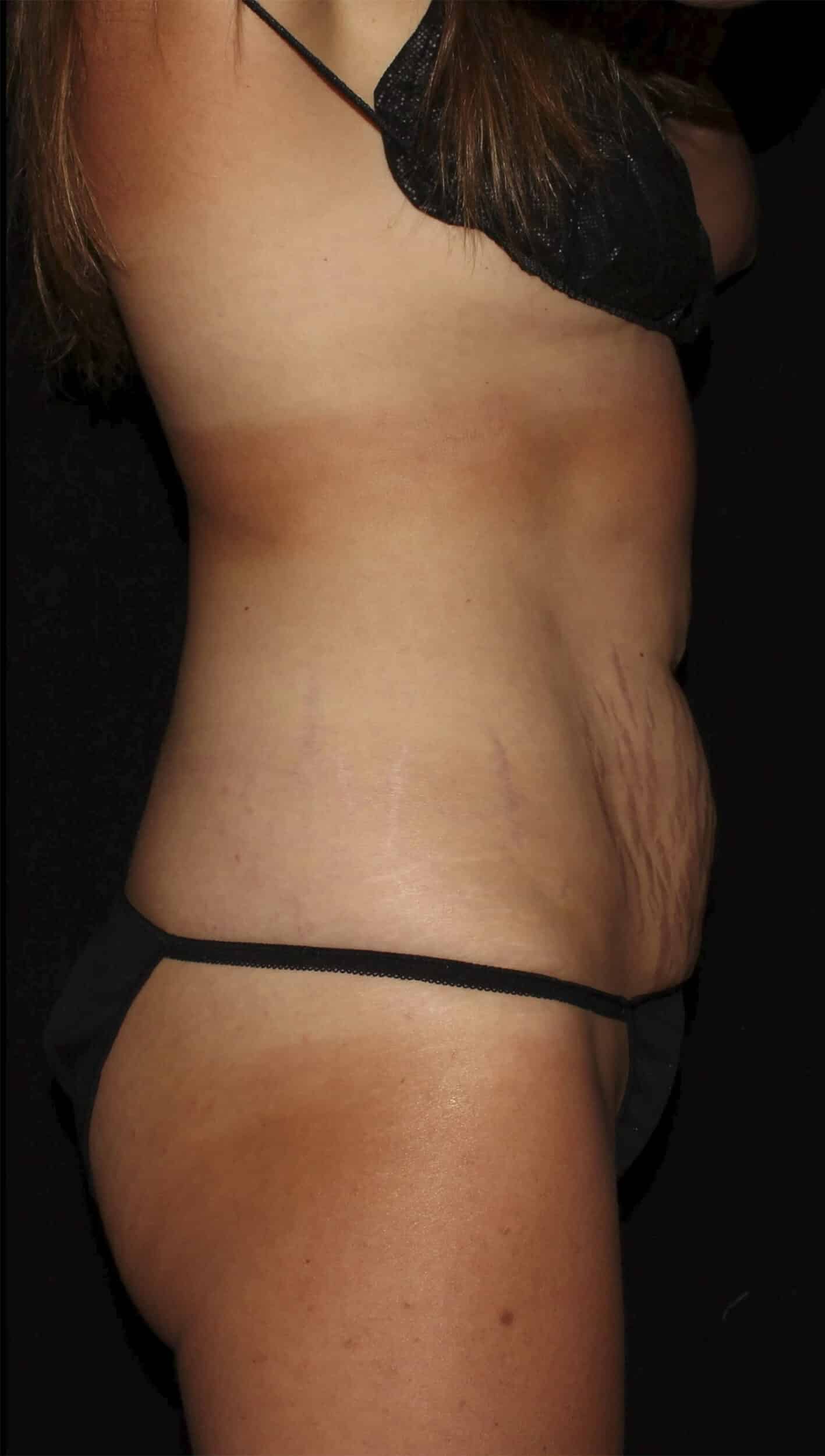 Before Image: Abdominoplasty - right-side