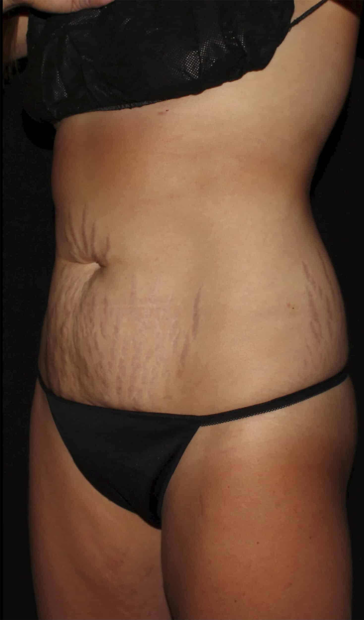 Before Image: Abdominoplasty - left-front-oblique