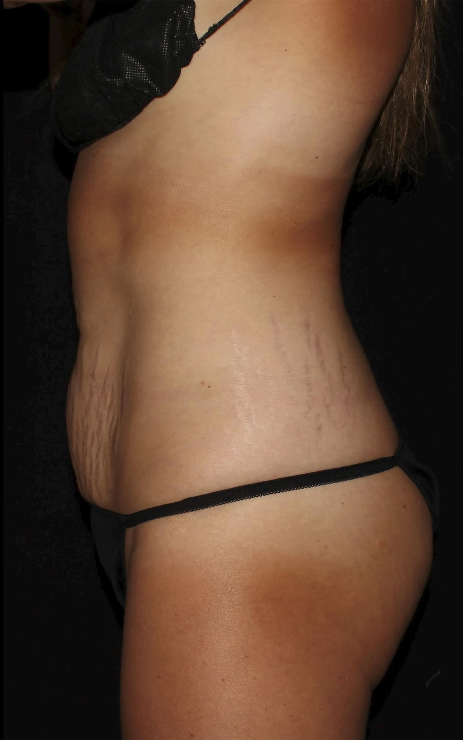 Before Image: Abdominoplasty - left-side