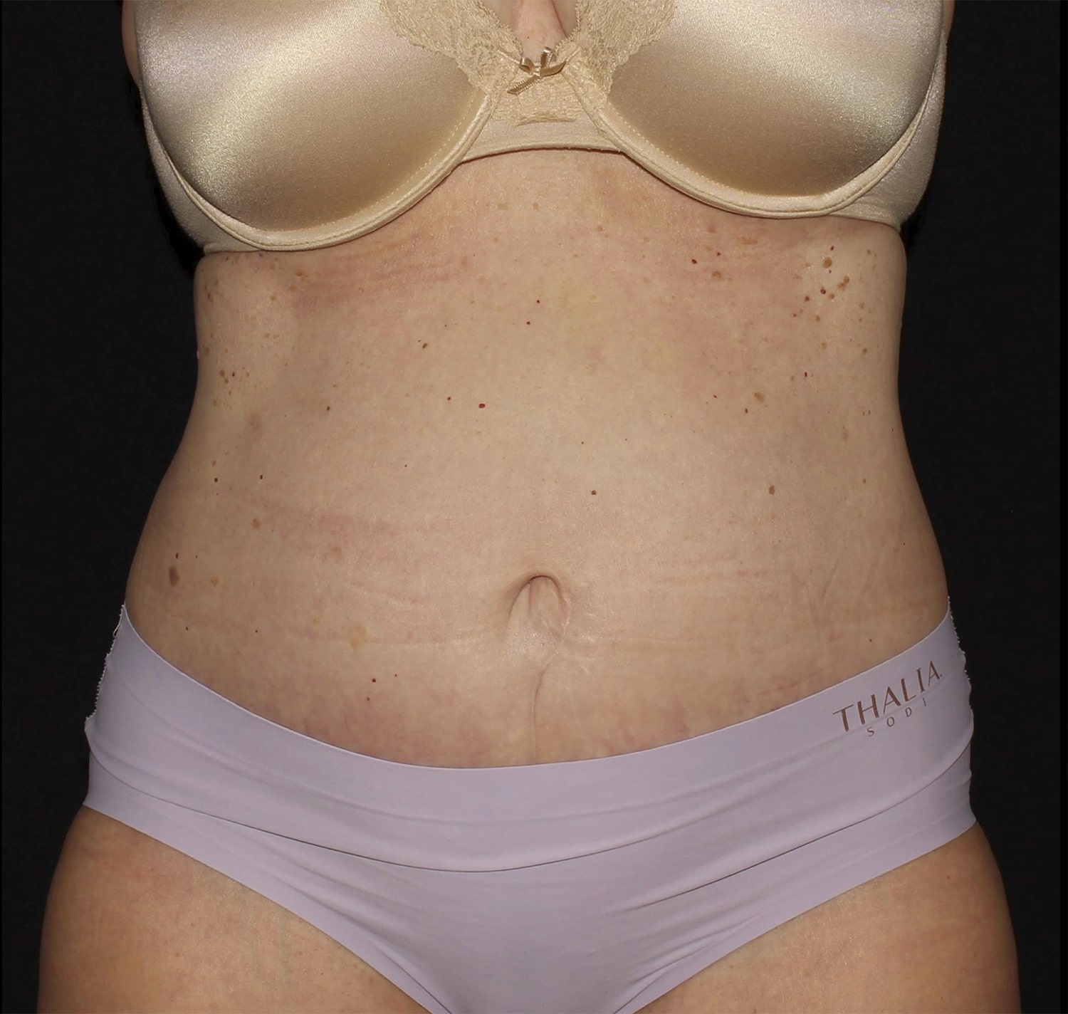 After Image: Abdominoplasty - front