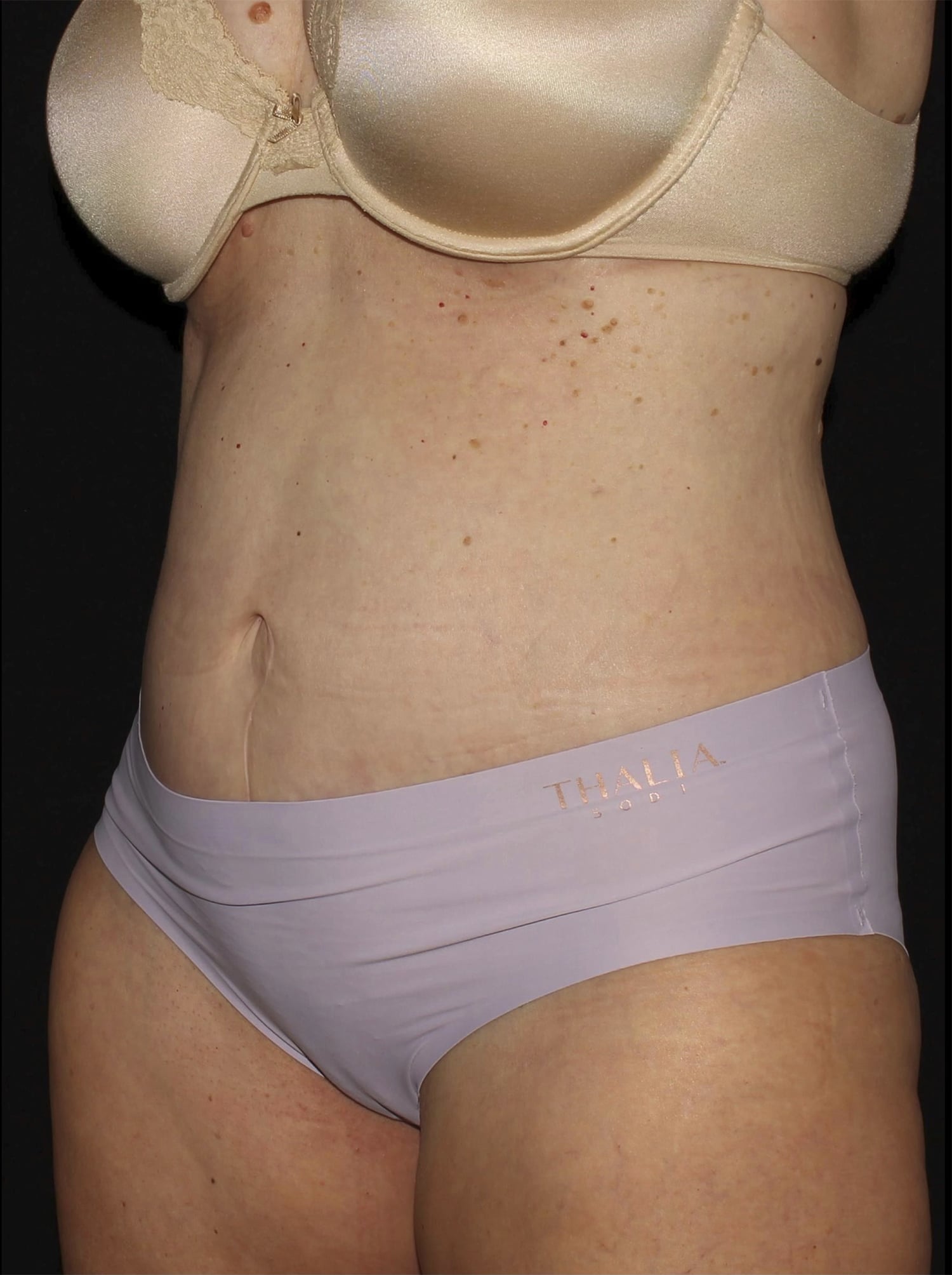 After Image: Abdominoplasty - left-front-oblique