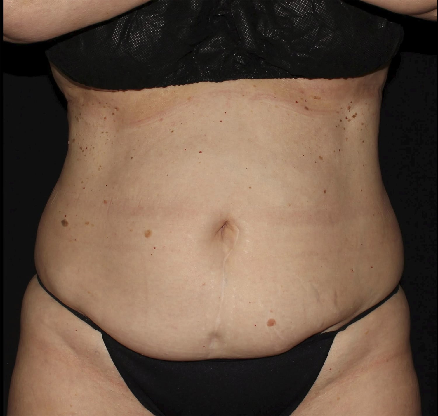 Before Image: Abdominoplasty - front