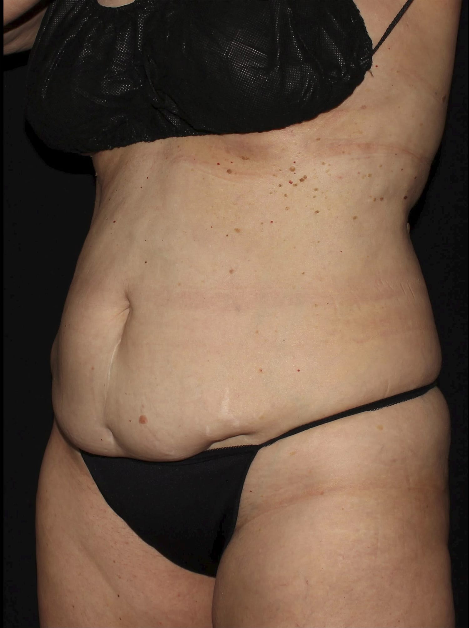 Before Image: Abdominoplasty - left-front-oblique