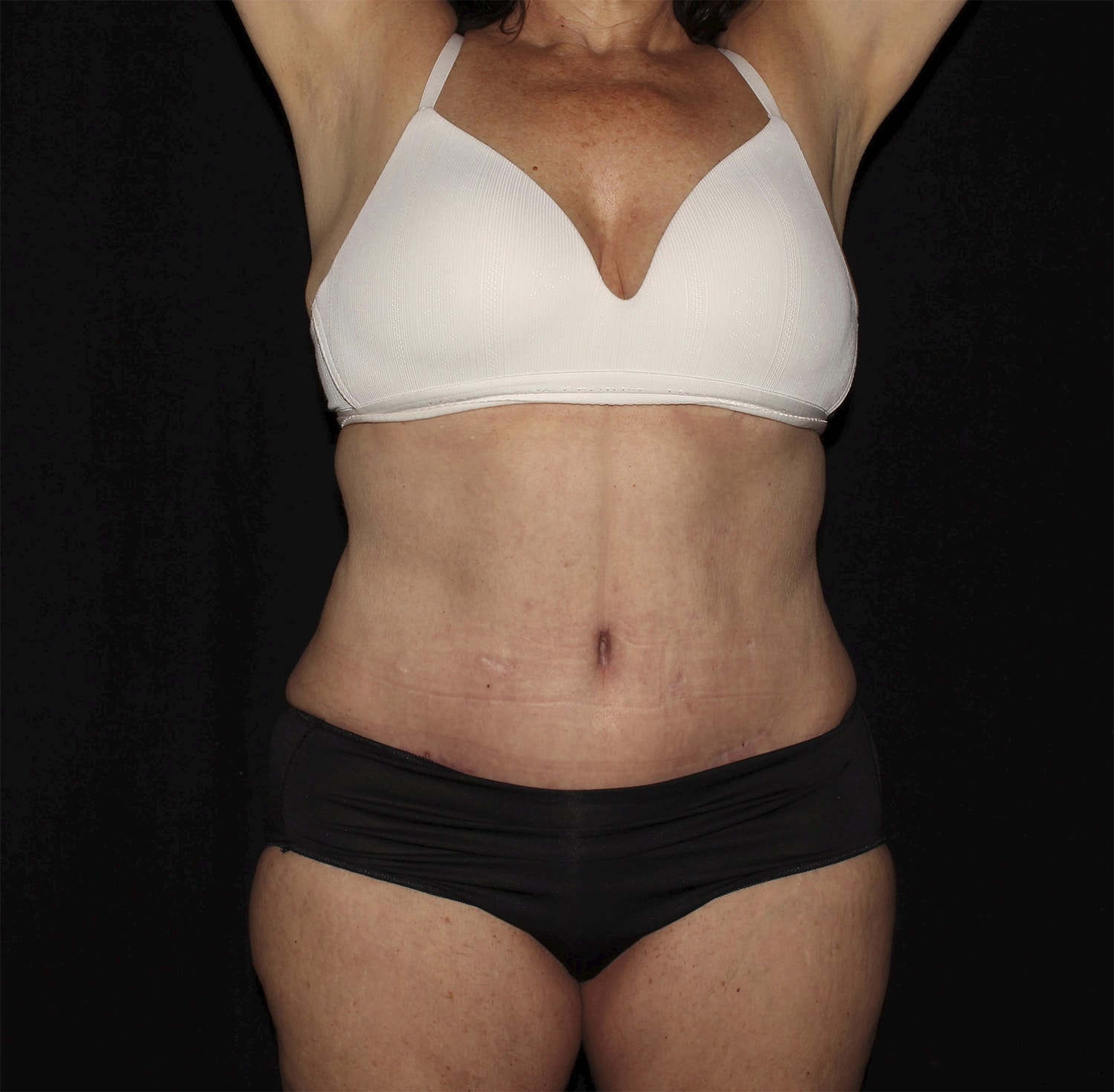 After Image: Abdominoplasty - front