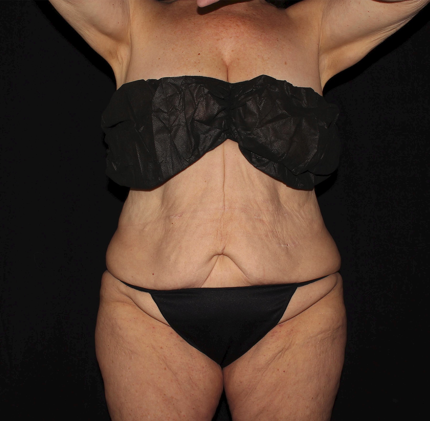 Before Image: Abdominoplasty - front