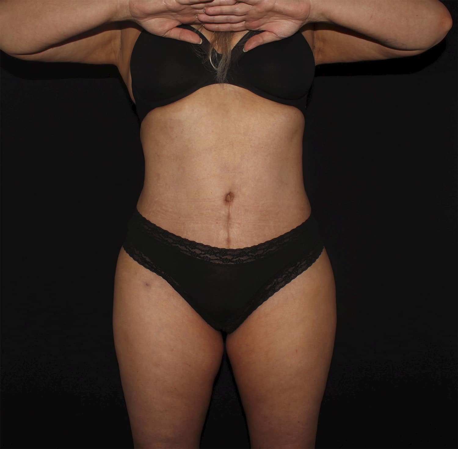 After Image: Tummy Tuck - front