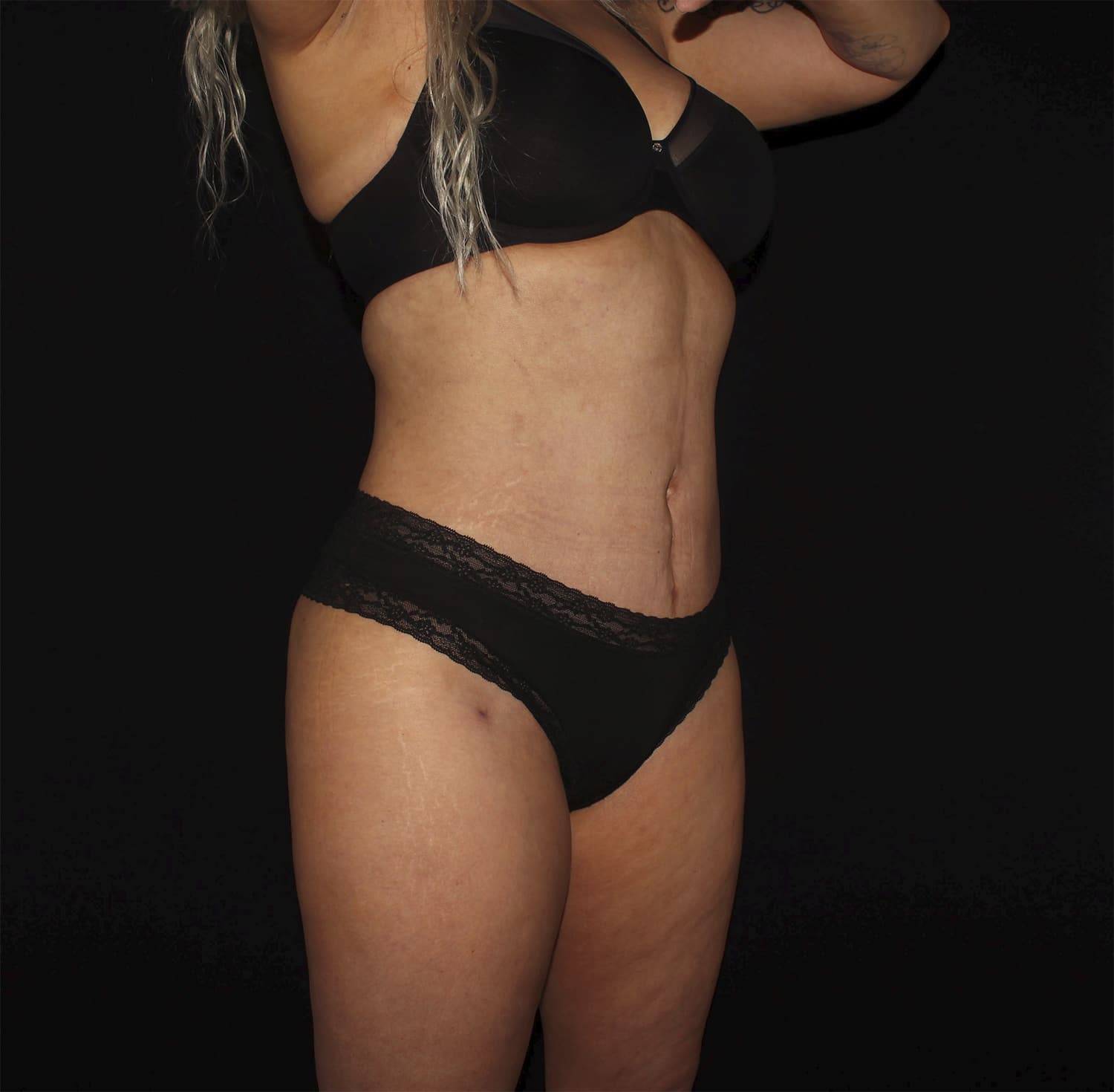 After Image: Tummy Tuck - right-front-oblique