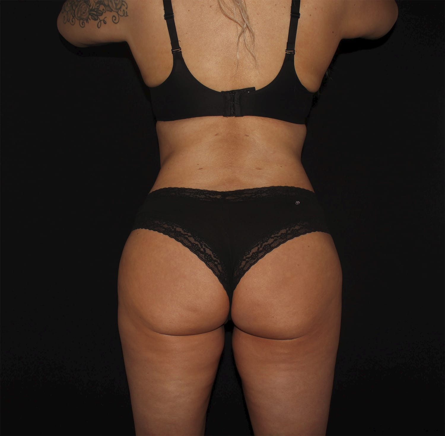 After Image: Tummy Tuck - back