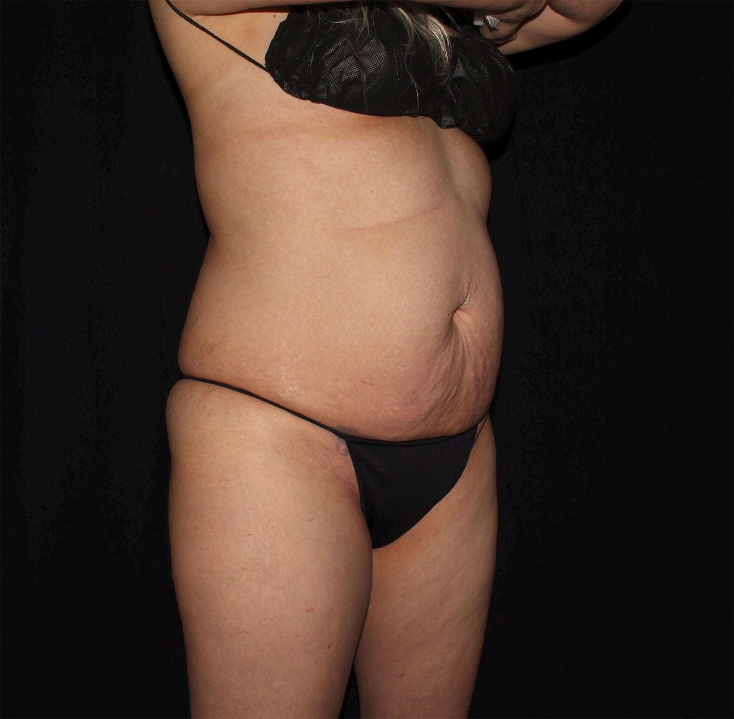 Before Image: Tummy Tuck - right-front-oblique