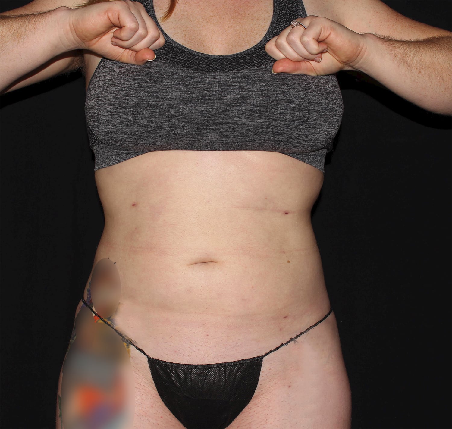 After Image: Abdomen & Waist - front