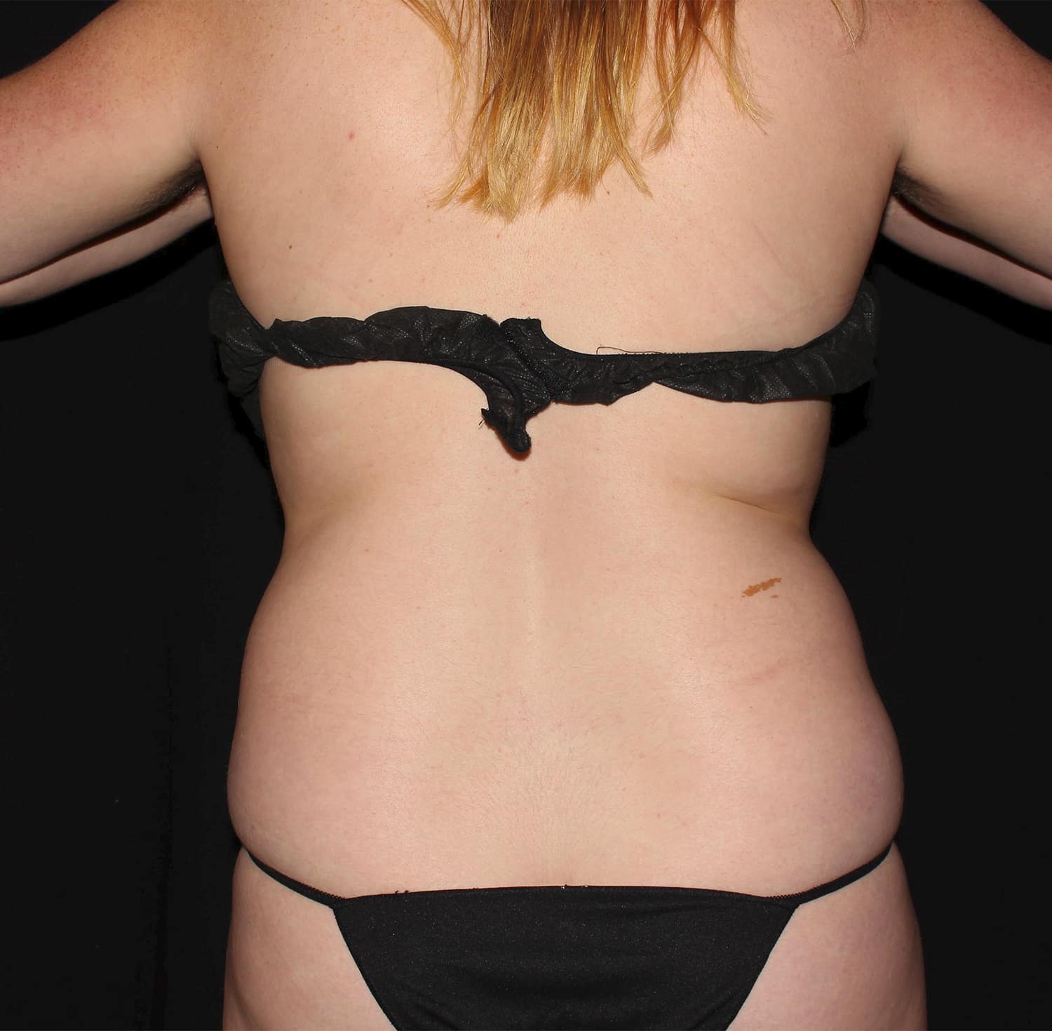 Before Image: Abdomen & Waist - back