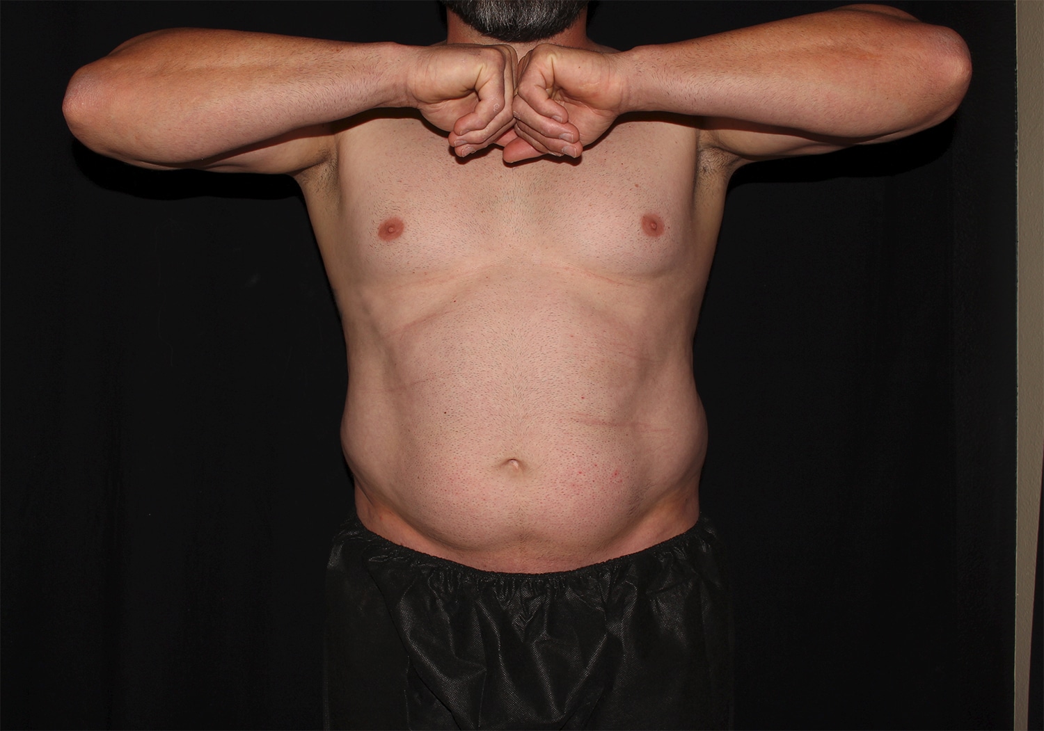 Before Image: Chest & Abdomen - front