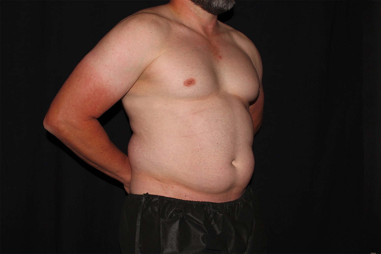 Before Image: Chest & Abdomen - right-front-oblique