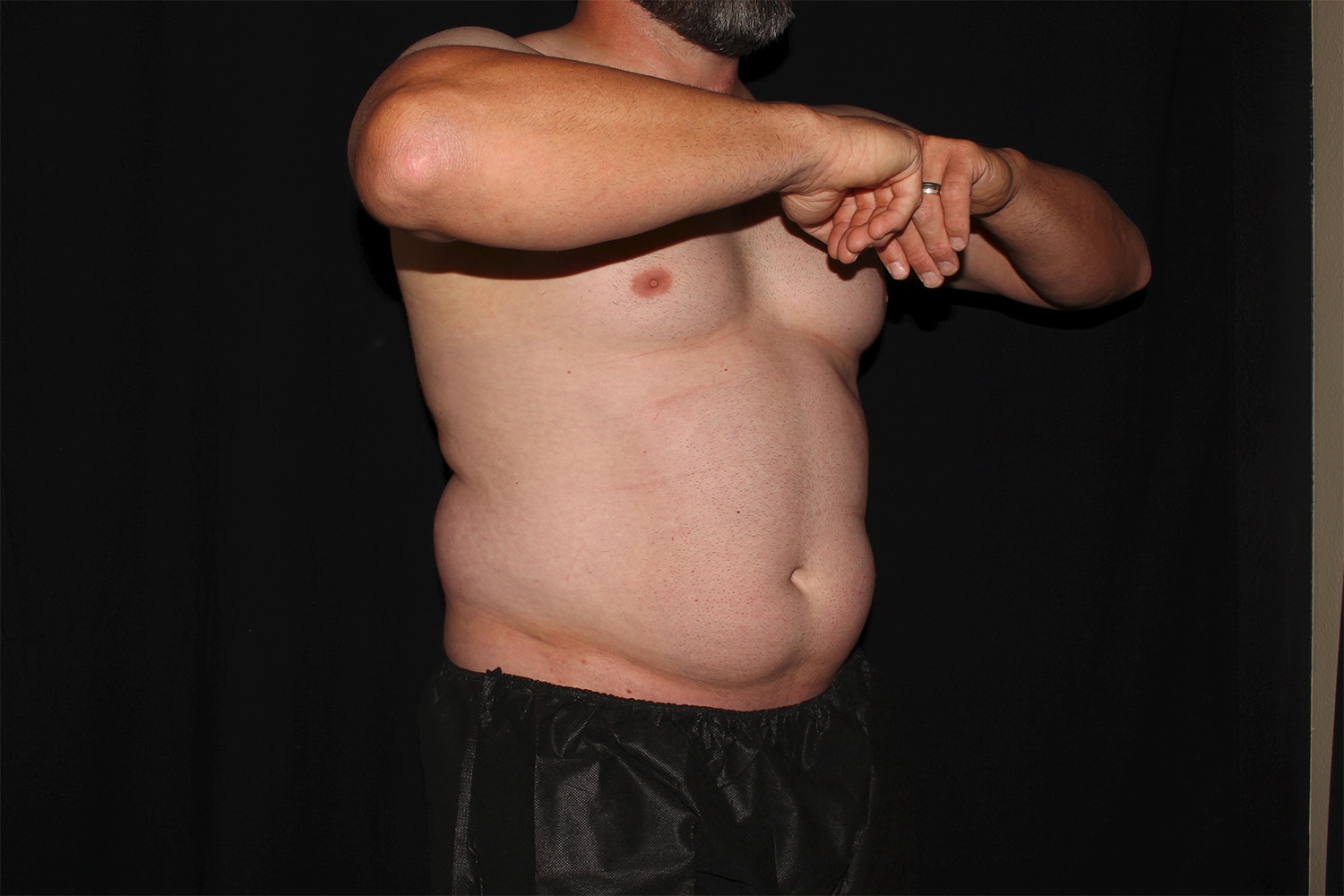 Before Image: Chest & Abdomen - right-front-oblique