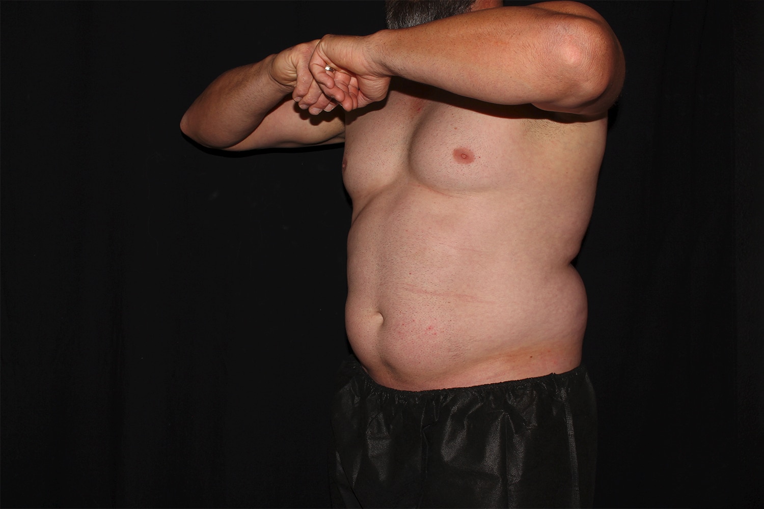 Before Image: Chest & Abdomen - left-front-oblique