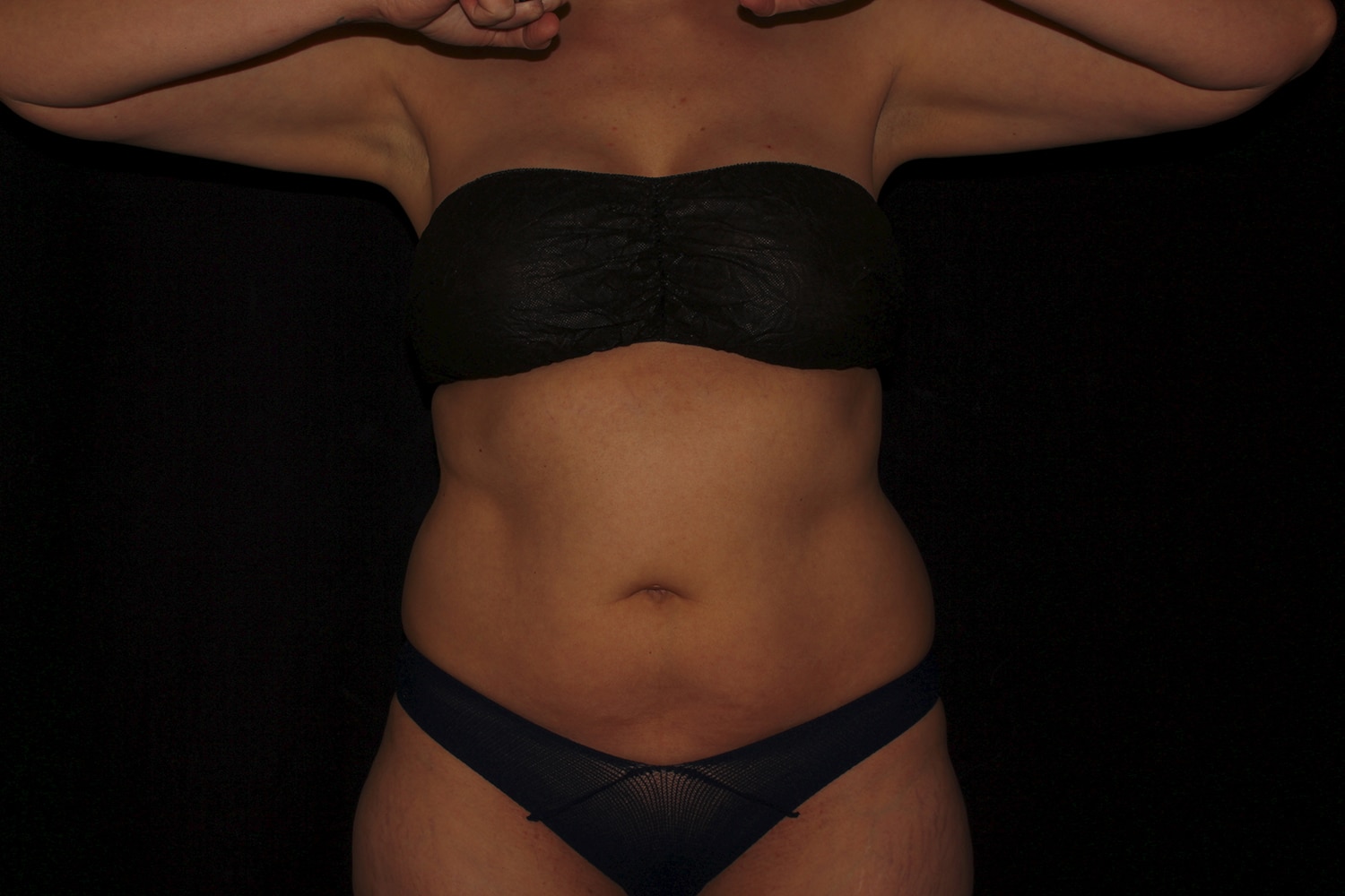 Before Image: Abdomen & Waist - front