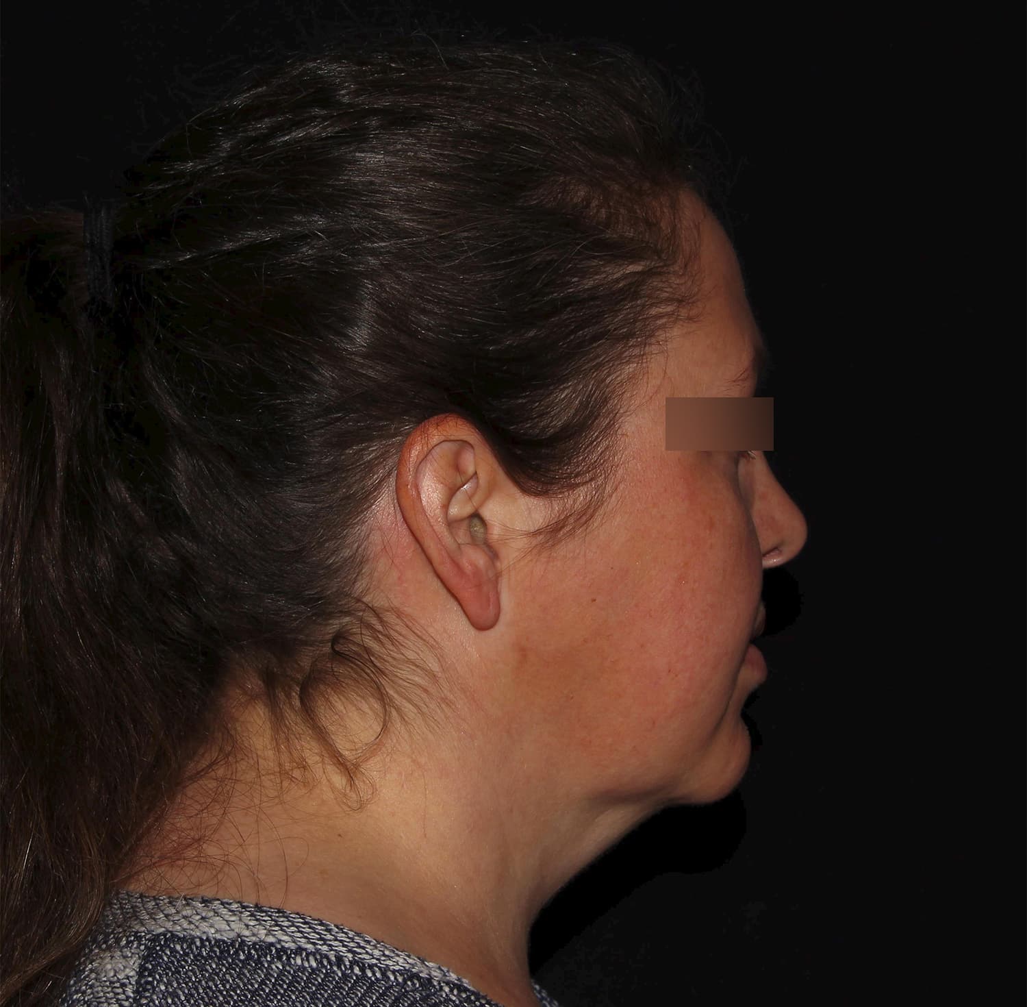 After Image: Neck - right-side