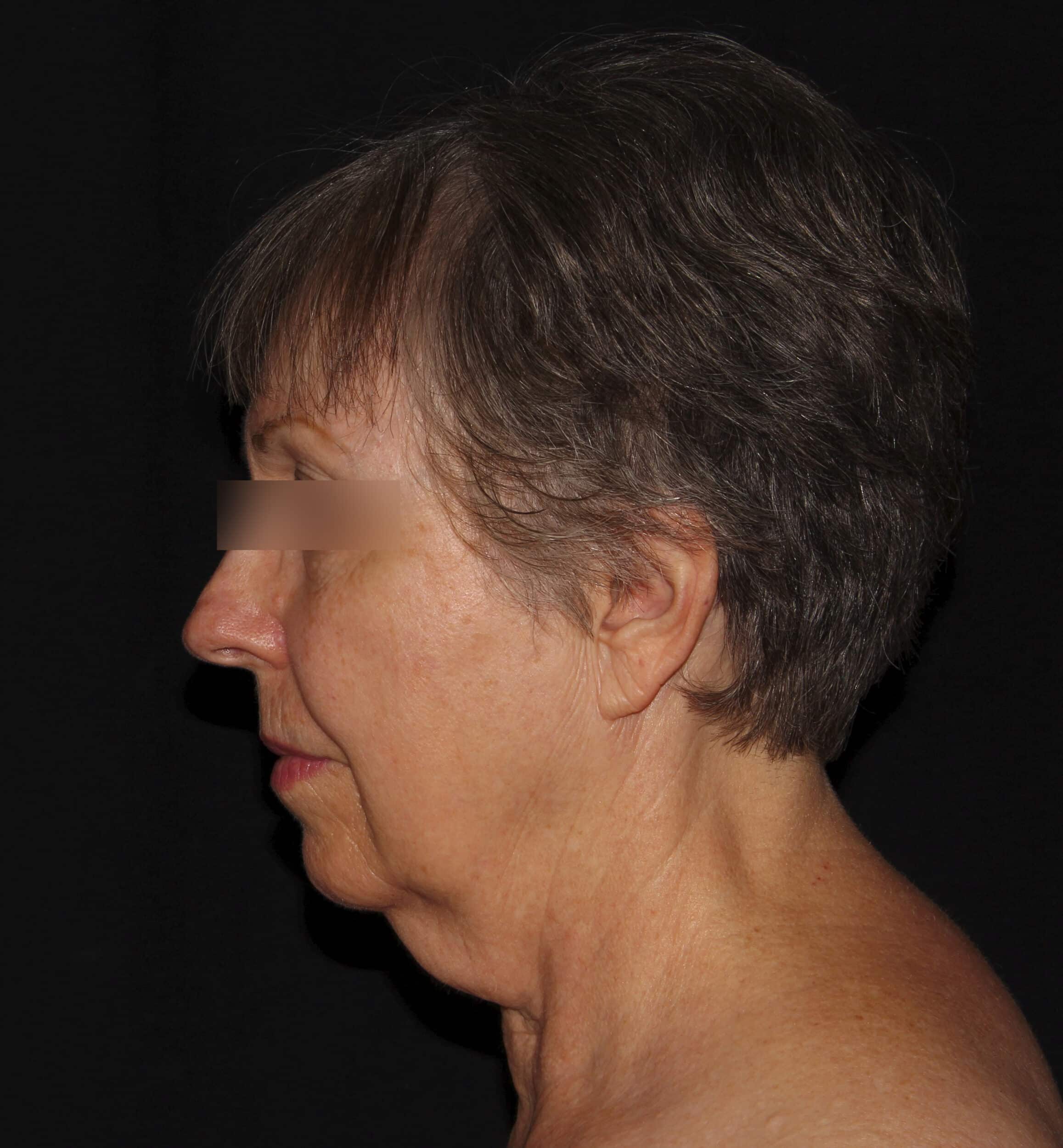 Before Image: Neck - left-side