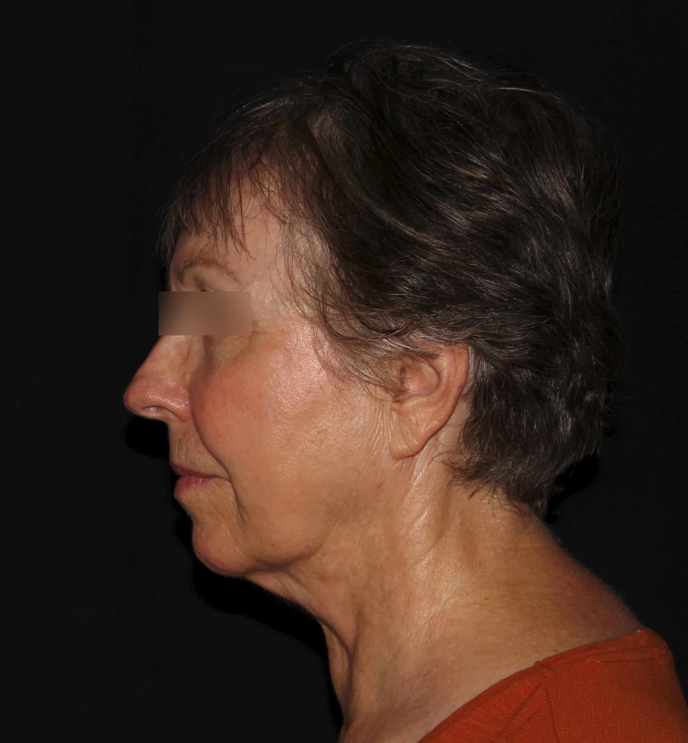 After Image: Neck - left-side