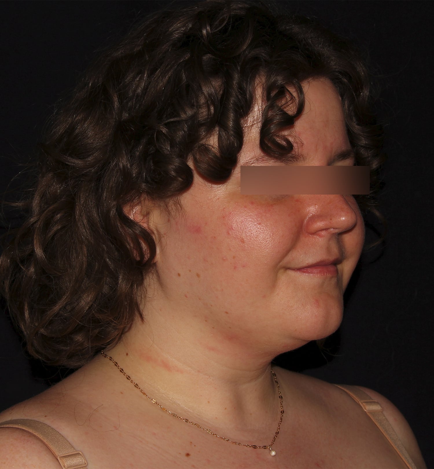 Before Image: Neck - right-front-oblique