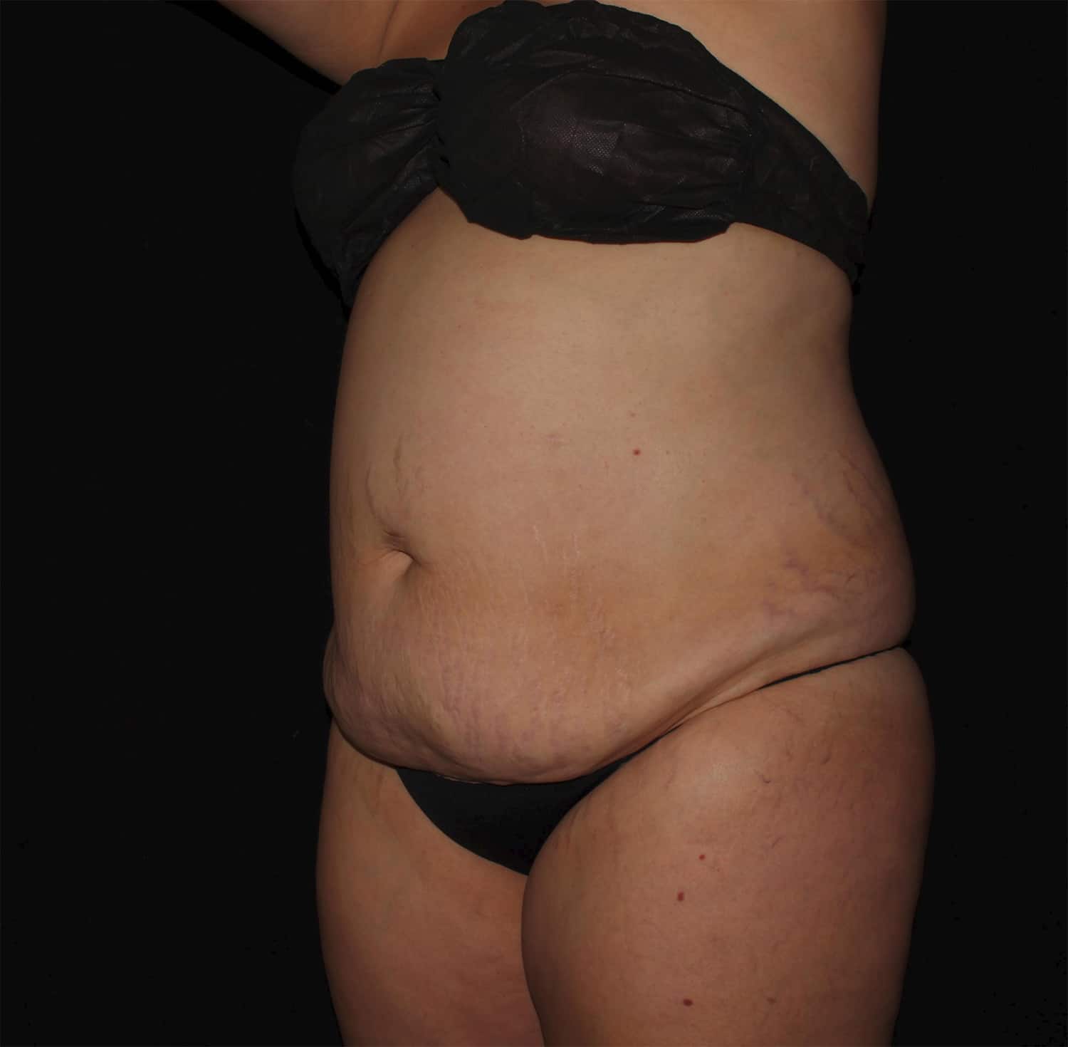 Before Image: Abdominoplasty - left-front-oblique