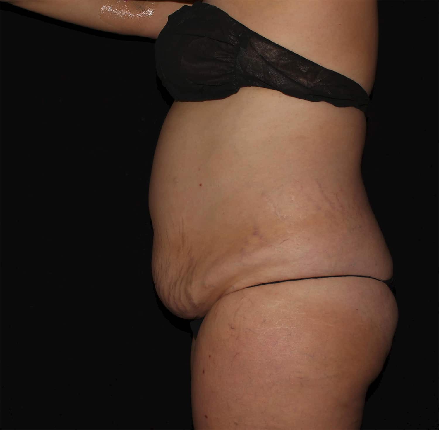 Before Image: Abdominoplasty - left-side