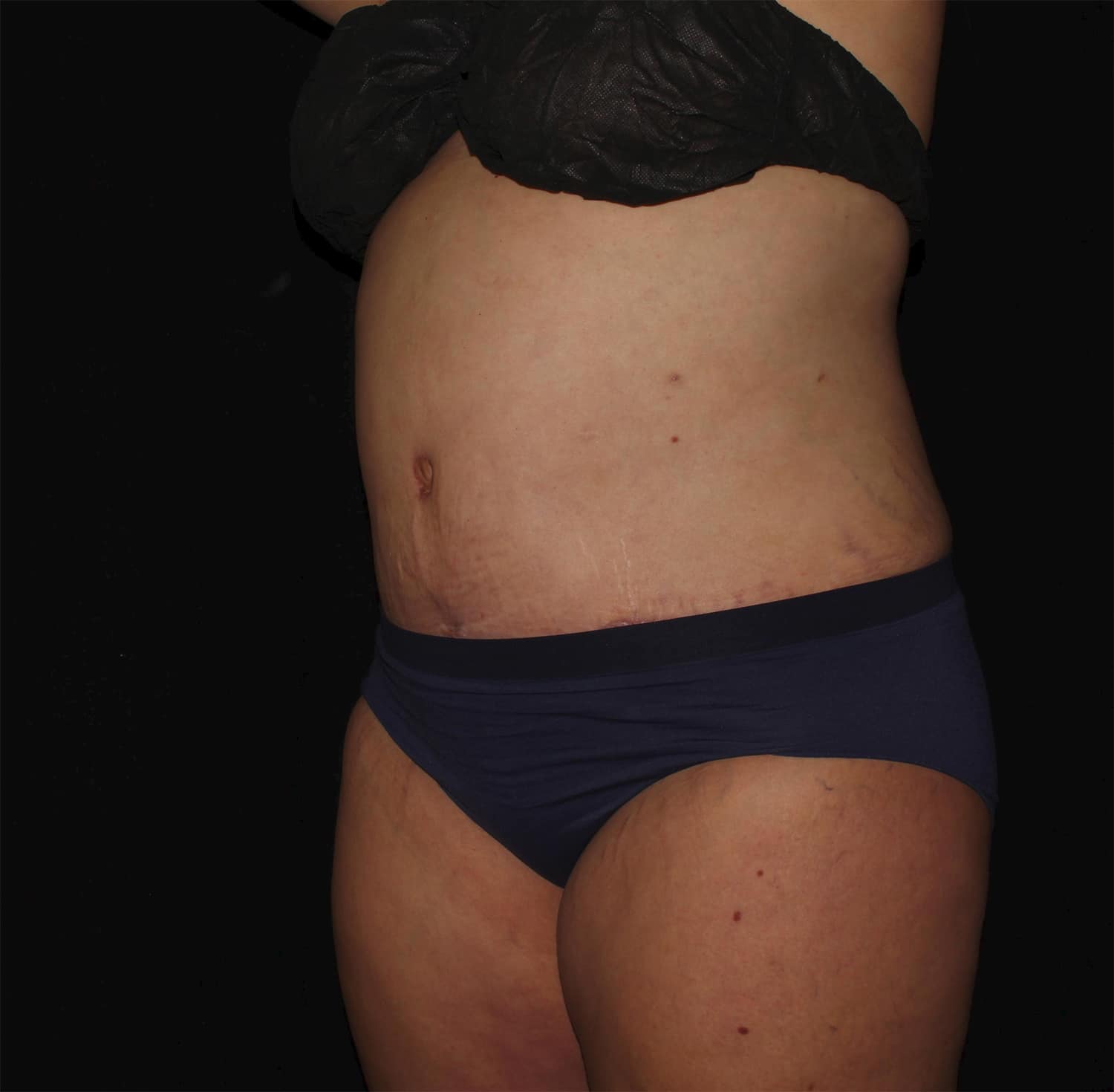 After Image: Abdominoplasty - left-front-oblique