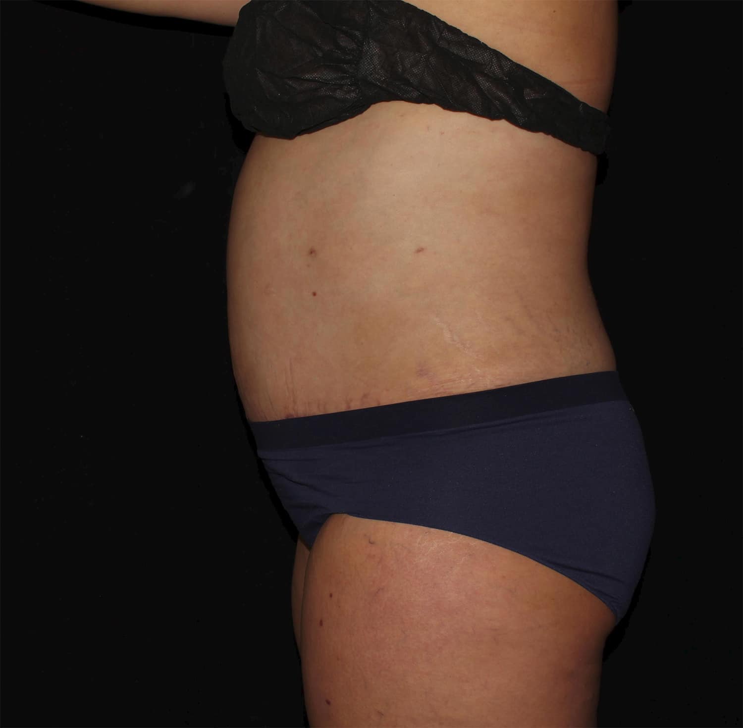 After Image: Abdominoplasty - left-side