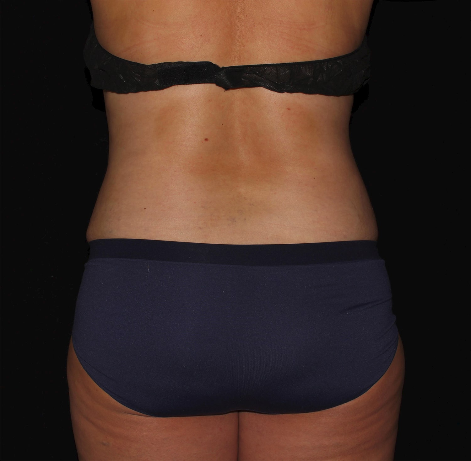 After Image: Abdominoplasty - back