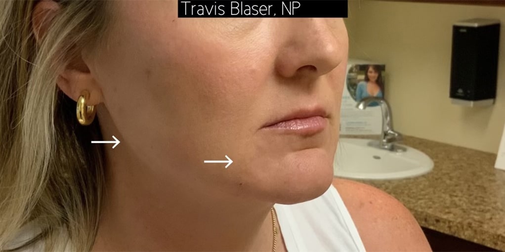 After Image: Jawline/Marionette Filler - right-front-oblique