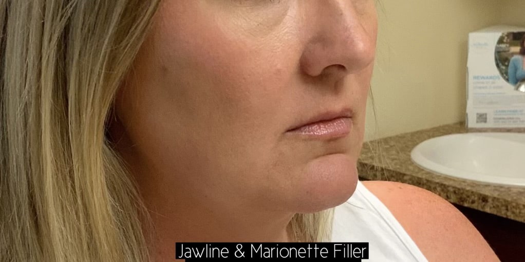 Before Image: Jawline/Marionette Filler - right-front-oblique