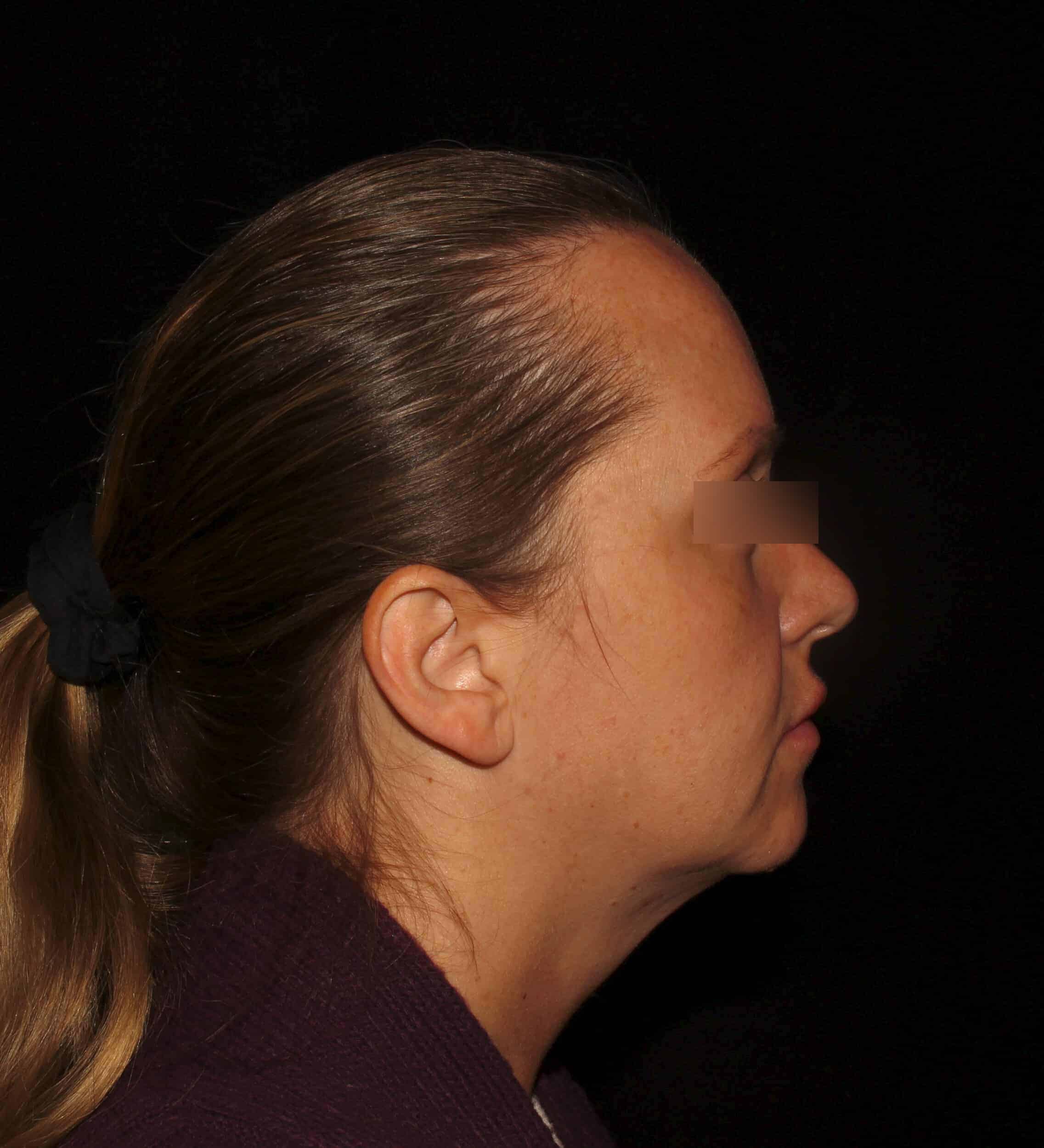 Before Image: NeoGraft Hair Transplant - right-side