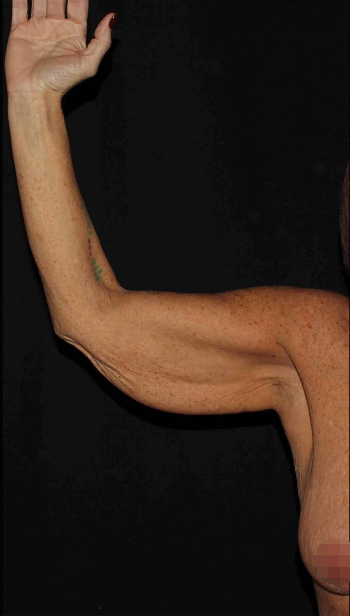 Before Image: Arm Lift - front