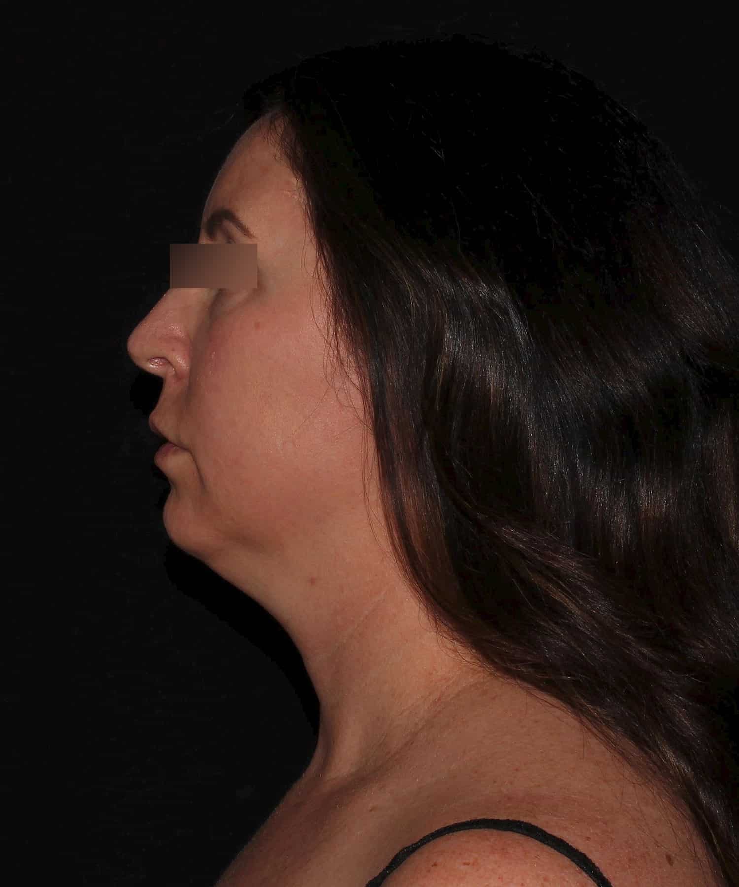 Before Image: Neck - left-side