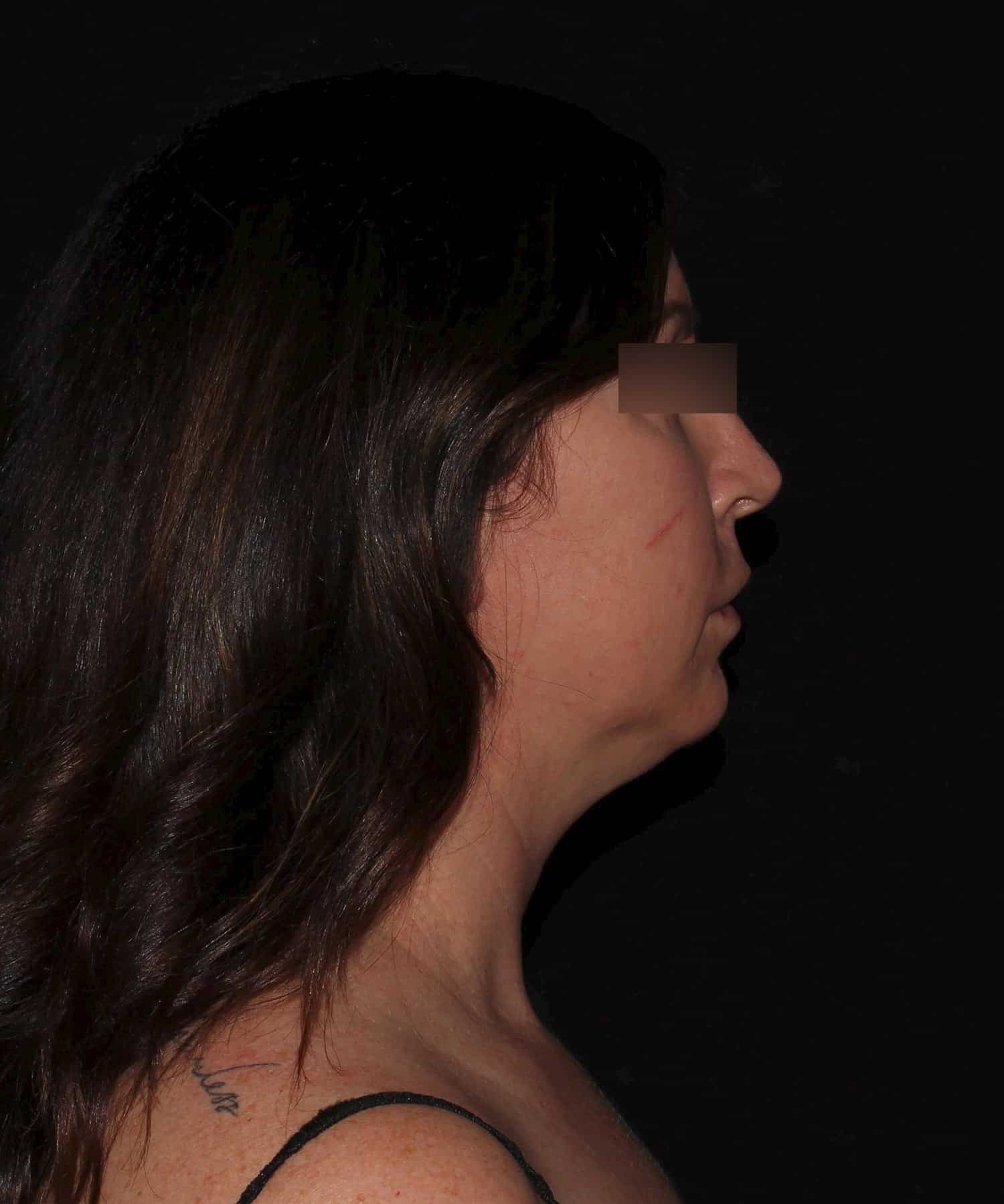 Before Image: Neck - right-side